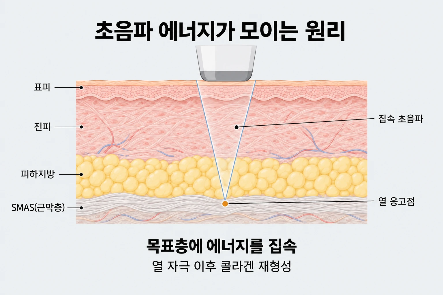 초음파 리프팅 에너지가 피부층을 지나 목표층에 모여 열 응고점을 형성하는 원리