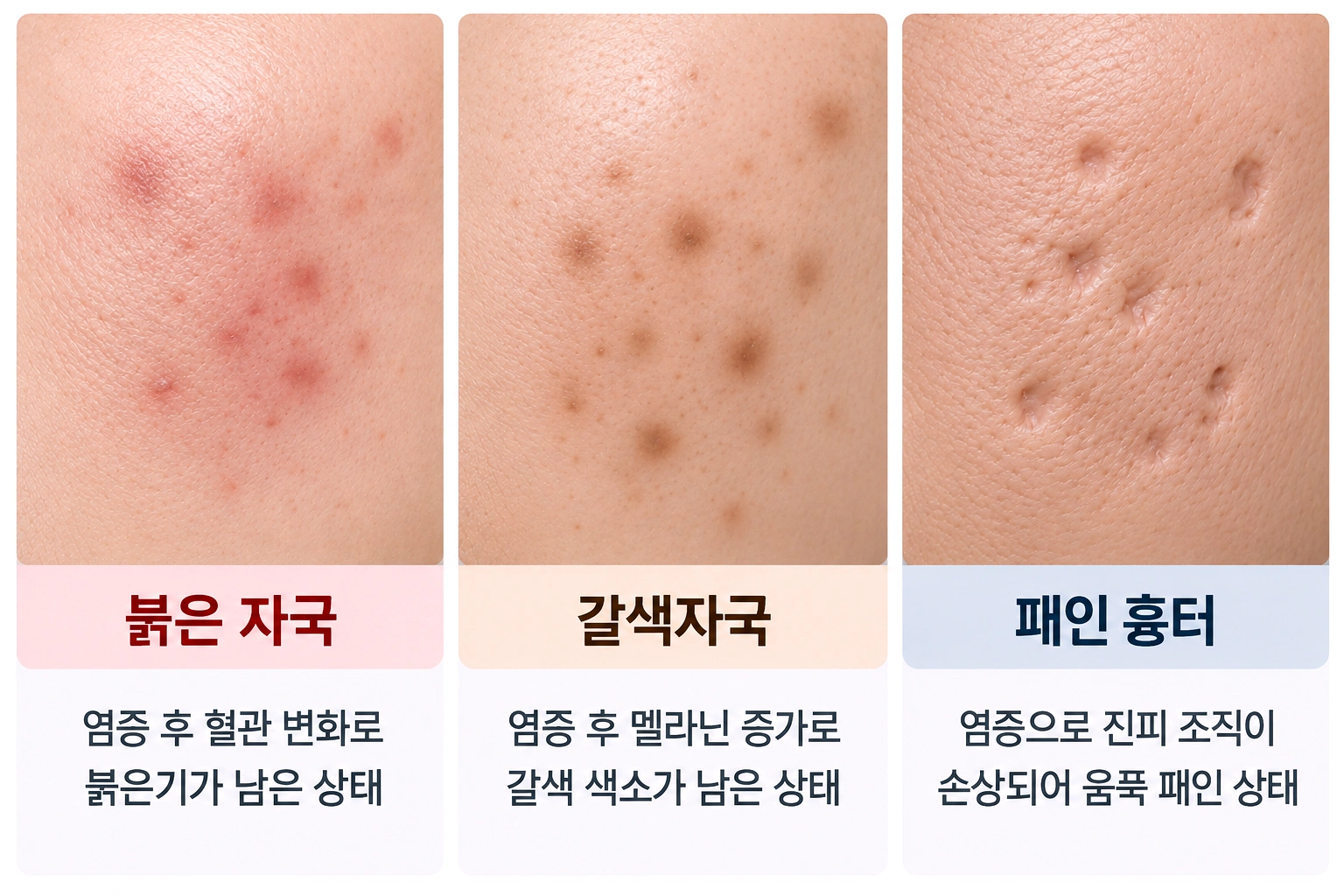 여드름 붉은 자국·갈색자국·패인 흉터의 차이