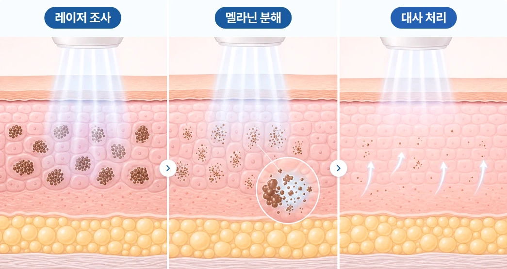 피코초 레이저 조사 후 멜라닌 색소가 미세하게 분해되고 피부의 대사 과정을 통해 서서히 정리되는 원리를 단계별로 나타낸 모식도