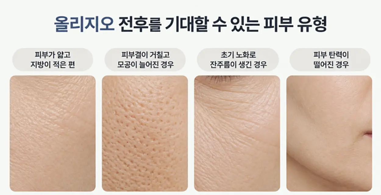 올리지오 전후 효과를 기대할 수 있는 피부 유형 4가지