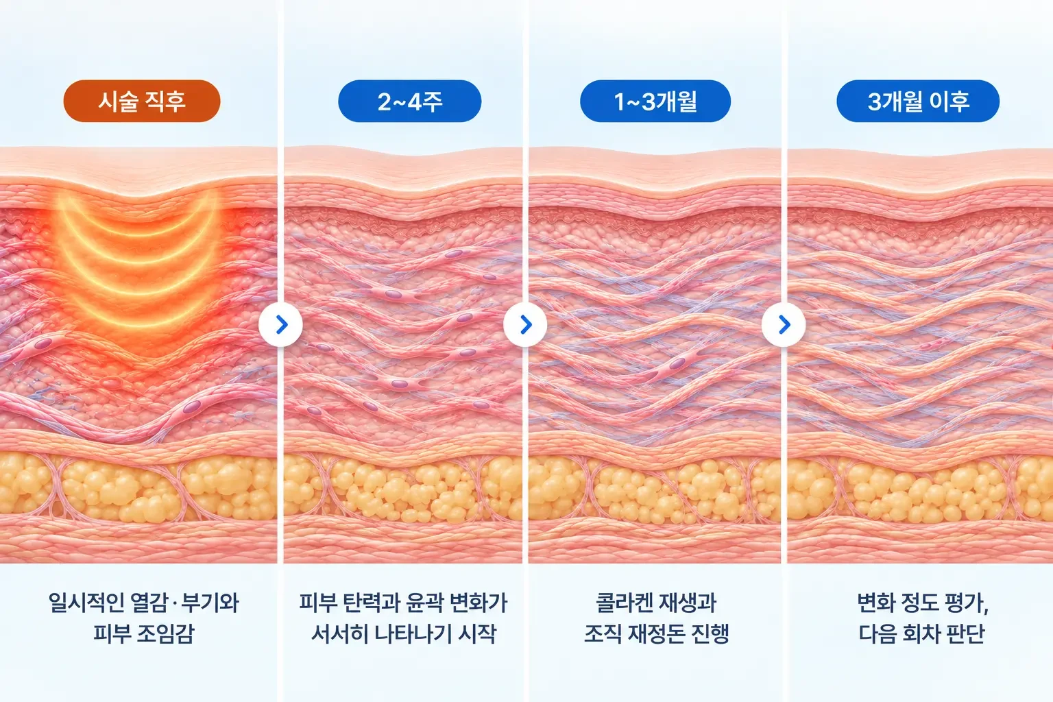 시술 직후부터 3개월 이후까지 섬유아세포와 콜라겐 섬유가 늘어나는 변화를 시기별로 그린 개념도