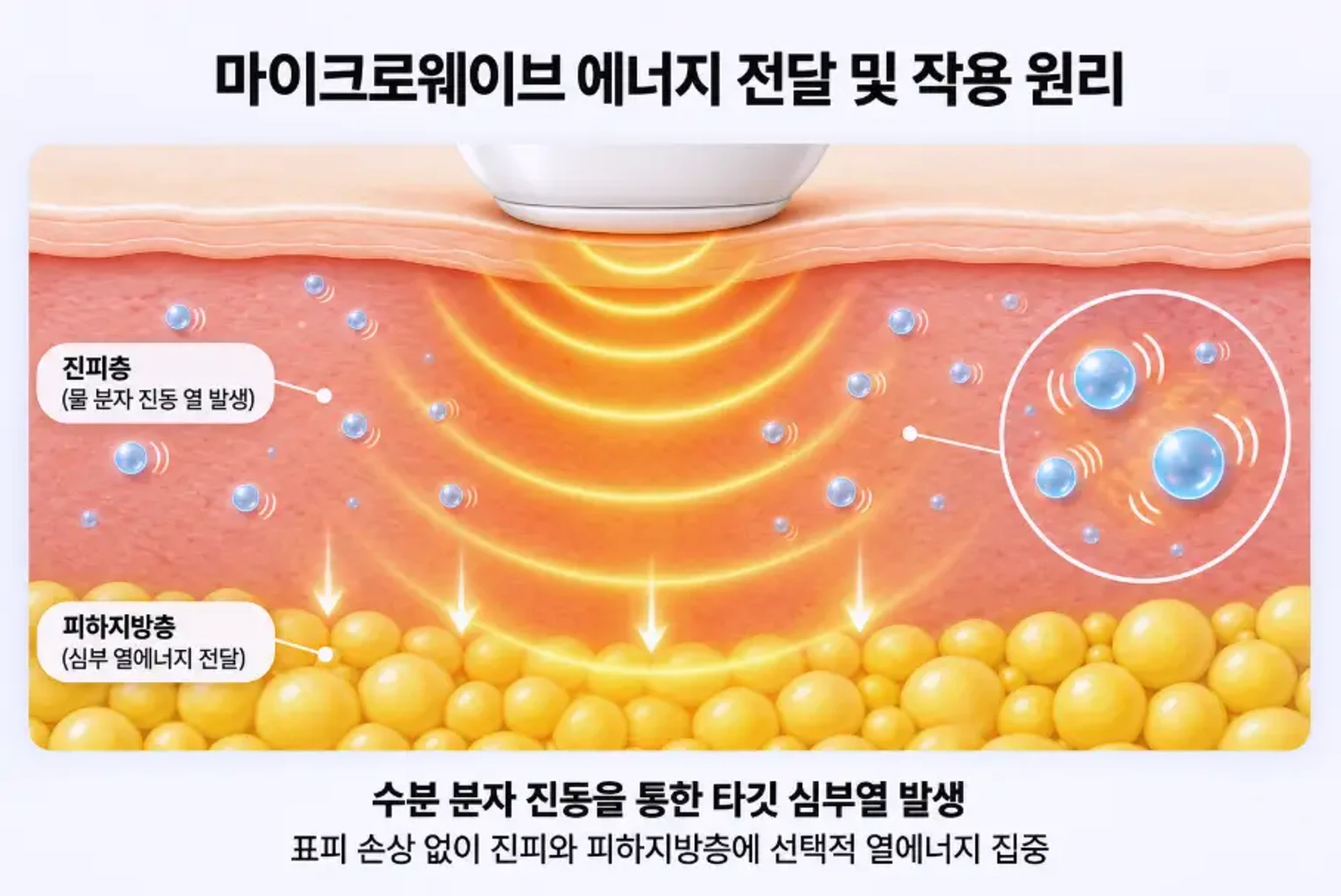 표피 손상 없이 진피 수분 분자를 진동시켜 피하지방층까지 열에너지를 전달하는 온다 레이저 극초단파 작용 원리