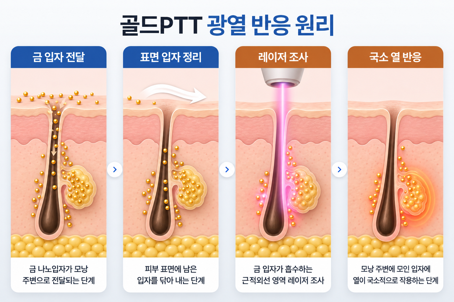 골드PTT 금 나노입자 전달부터 레이저 조사와 모낭 주변 국소 열 반응까지의 과정