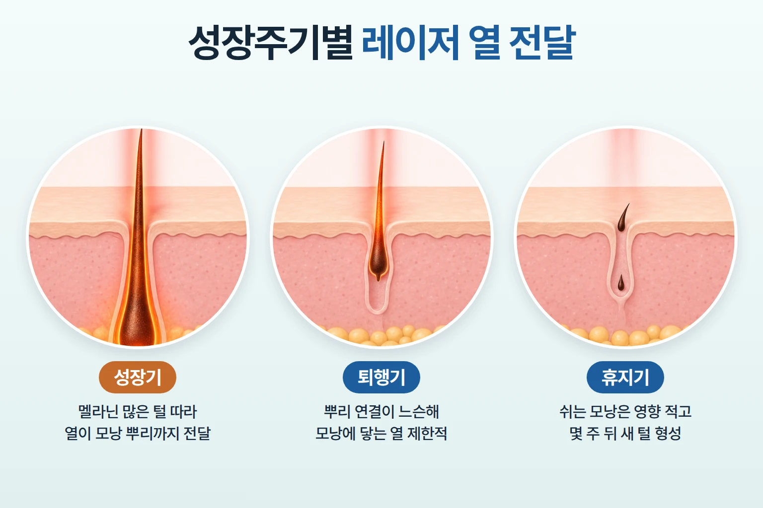 성장기, 퇴행기, 휴지기 모낭에 레이저 열이 전달되는 정도를 나란히 비교한 피부 단면 일러스트