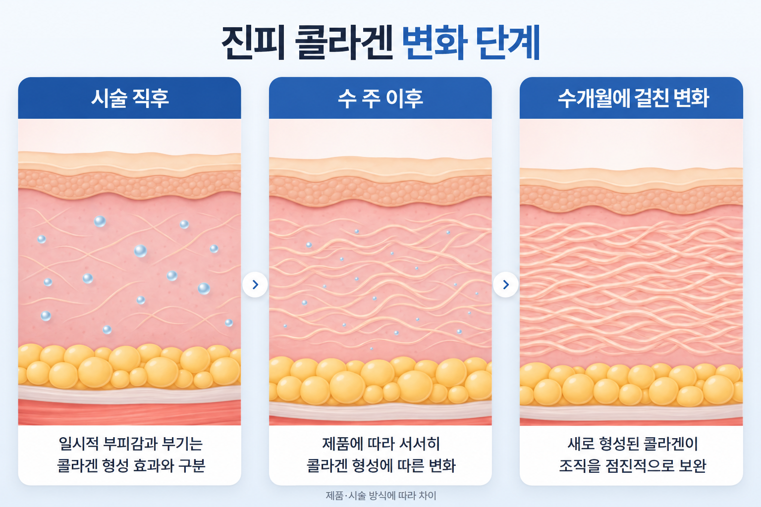콜라겐 주사 시술 직후부터 수 주, 수개월에 걸쳐 진피 속 콜라겐 섬유가 점진적으로 형성되는 과정과 초기 부피 변화의 차이