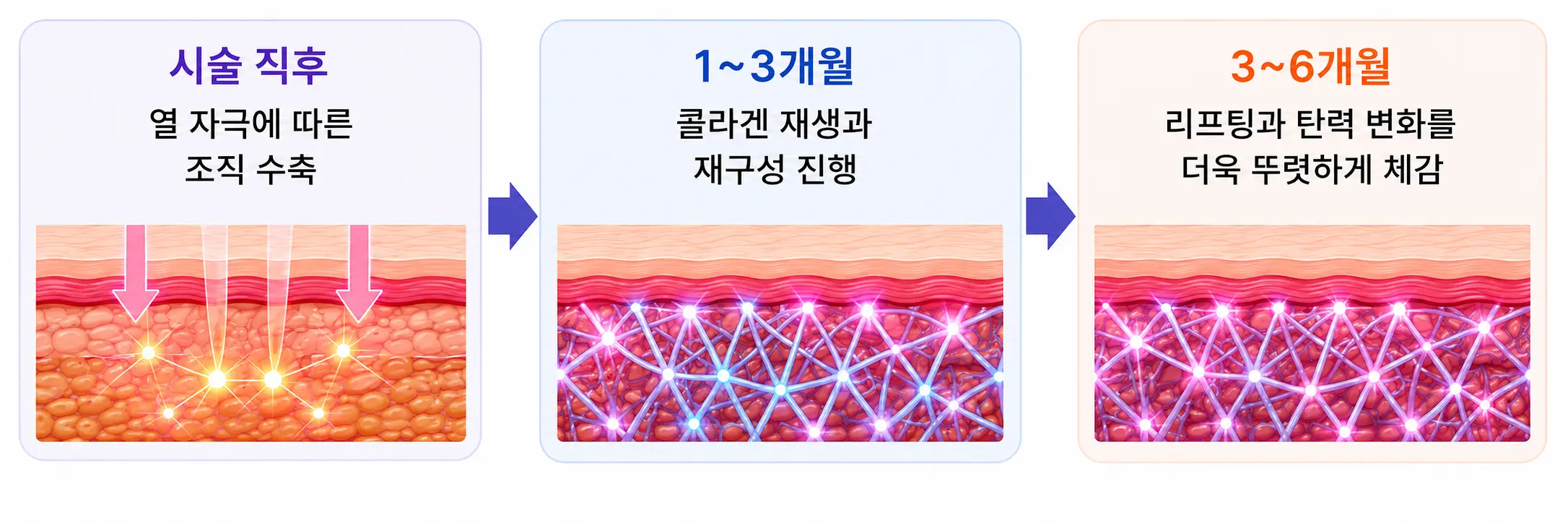 울쎄라 300샷 시술 후 콜라겐 재구성 기간