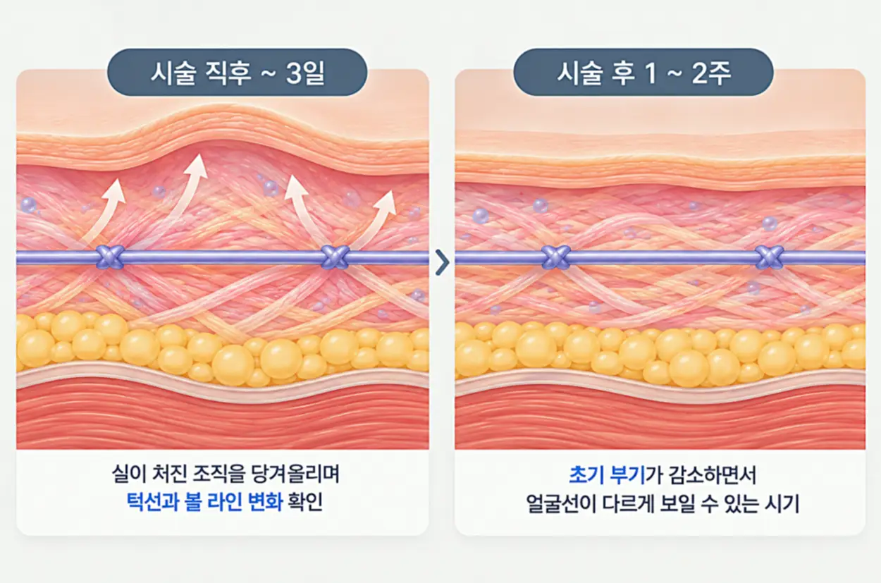 실리프팅 시술 직후부터 2주까지 피부 조직과 얼굴선의 변화 비교