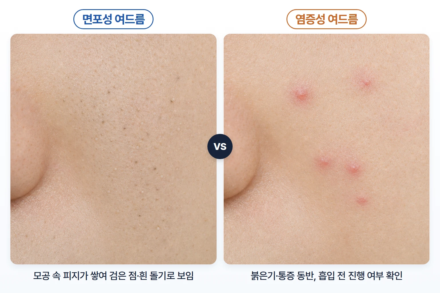 모공 속 피지가 쌓인 면포성 여드름과 붉은 염증성 여드름의 외형을 나란히 담은 피부 표면 비교 사진