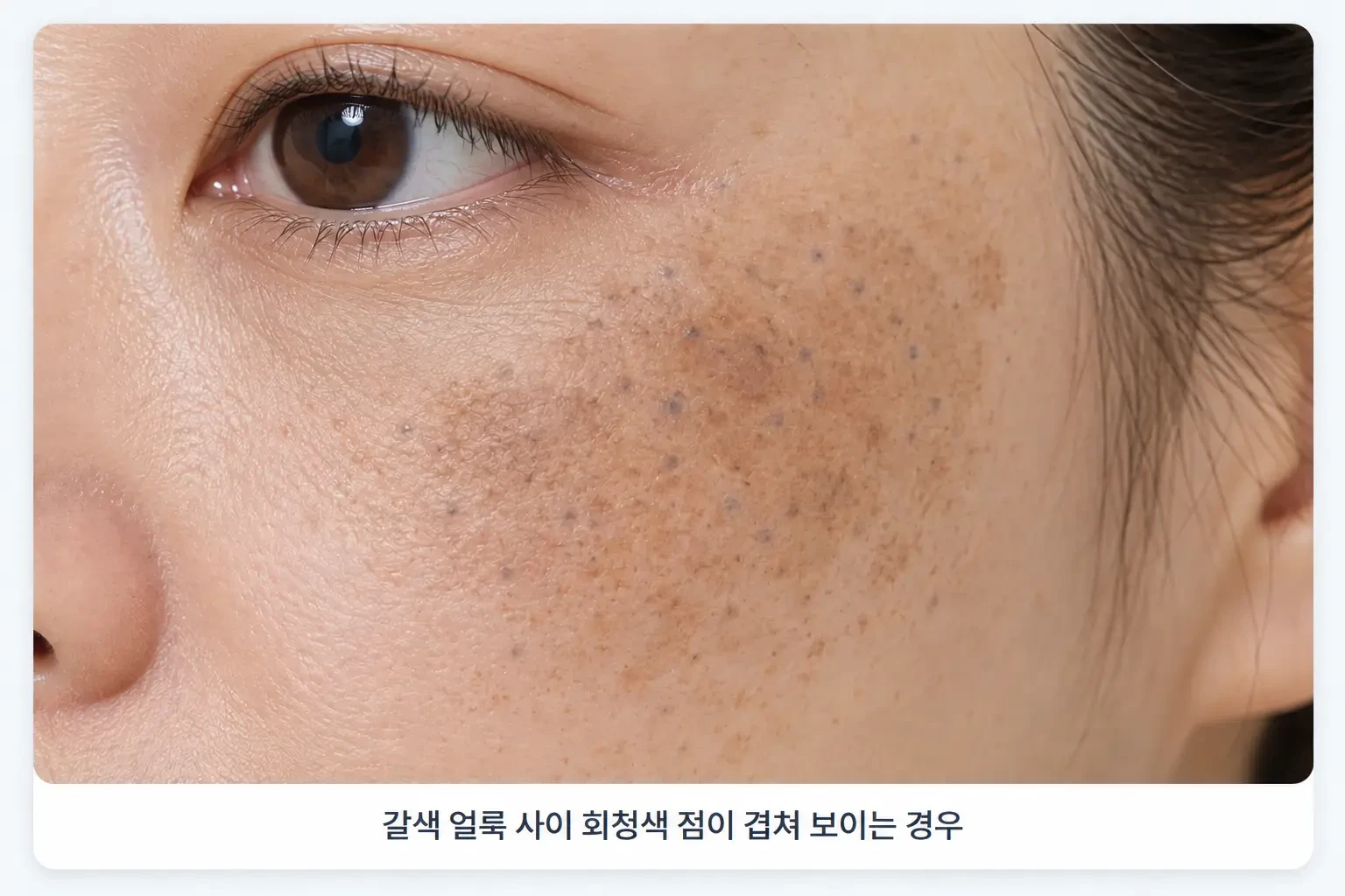 갈색 기미 얼룩 사이로 회청색 후천성 오타모반 점이 겹쳐 박힌 광대 피부를 확대한 사진