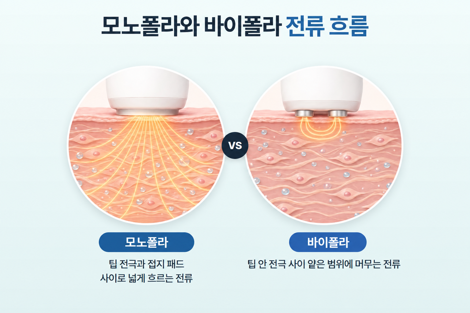 모노폴라의 팁·접지 패드 전류 흐름과 바이폴라의 팁 내부 전극 전류 흐름 비교
