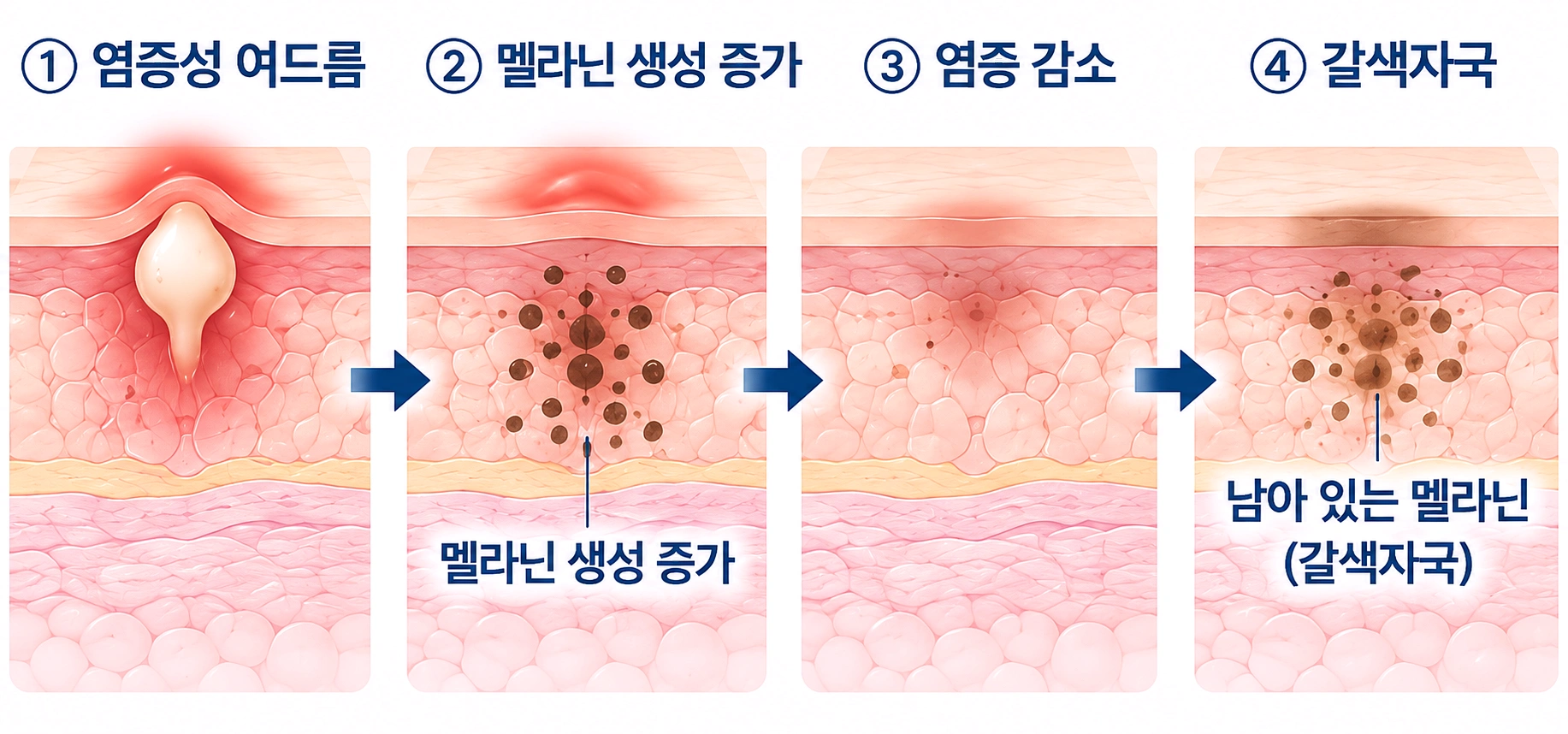 염증성 여드름 후 멜라닌 생성이 증가하고 염증이 가라앉은 뒤 갈색자국이 남는 과정을 단계별로 나타낸 피부 단면도
