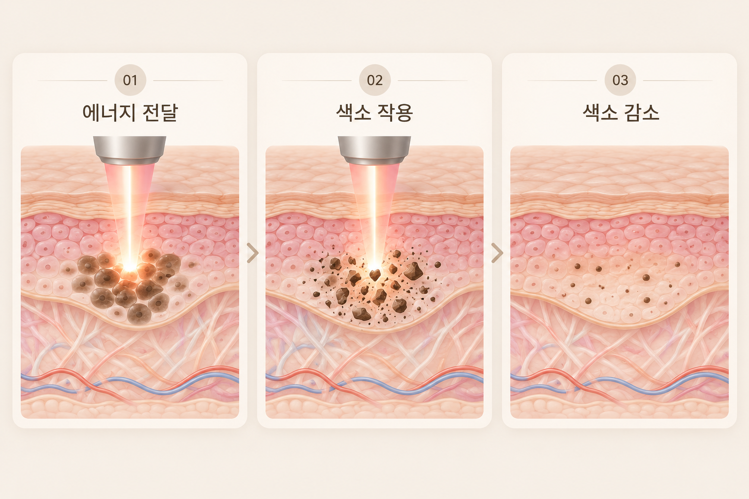 기미 레이저 에너지가 멜라닌 색소에 작용해 색소가 감소하는 3단계 과정