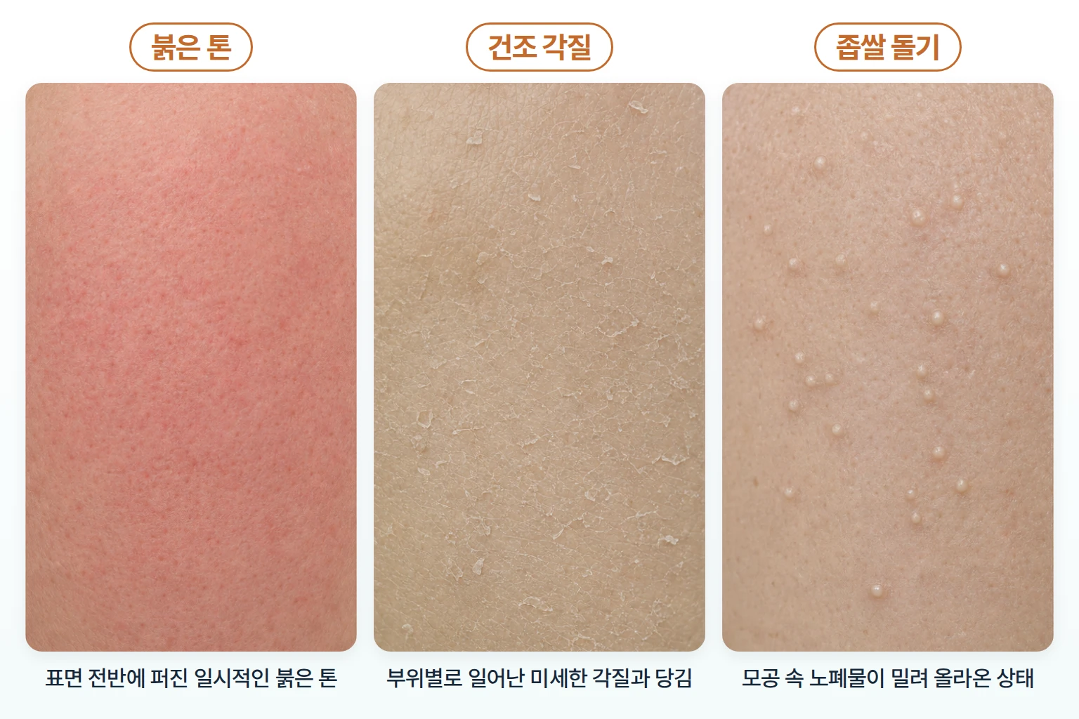 붉은 톤, 미세 각질, 좁쌀 형태 돌기의 표면 양상을 같은 배율로 비교한 피부 확대 사진
