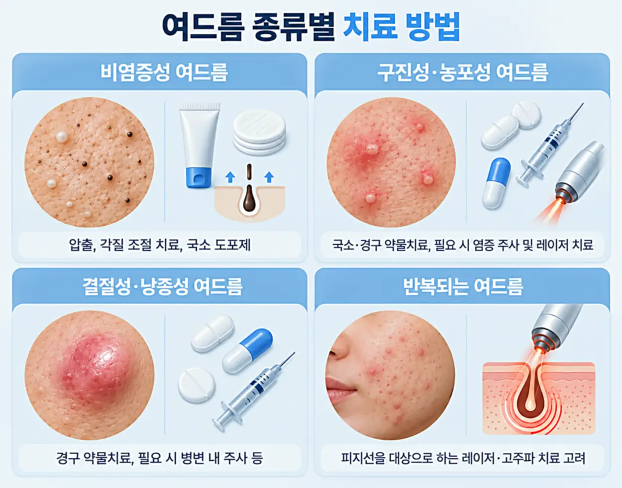 여드름 종류별 치료 방법을 나타내는 이미지