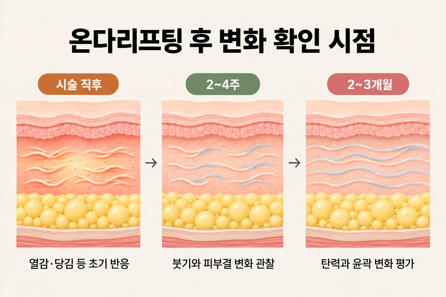 온다리프팅 직후와 2~4주·2~3개월의 피부 반응 및 탄력·윤곽 점검