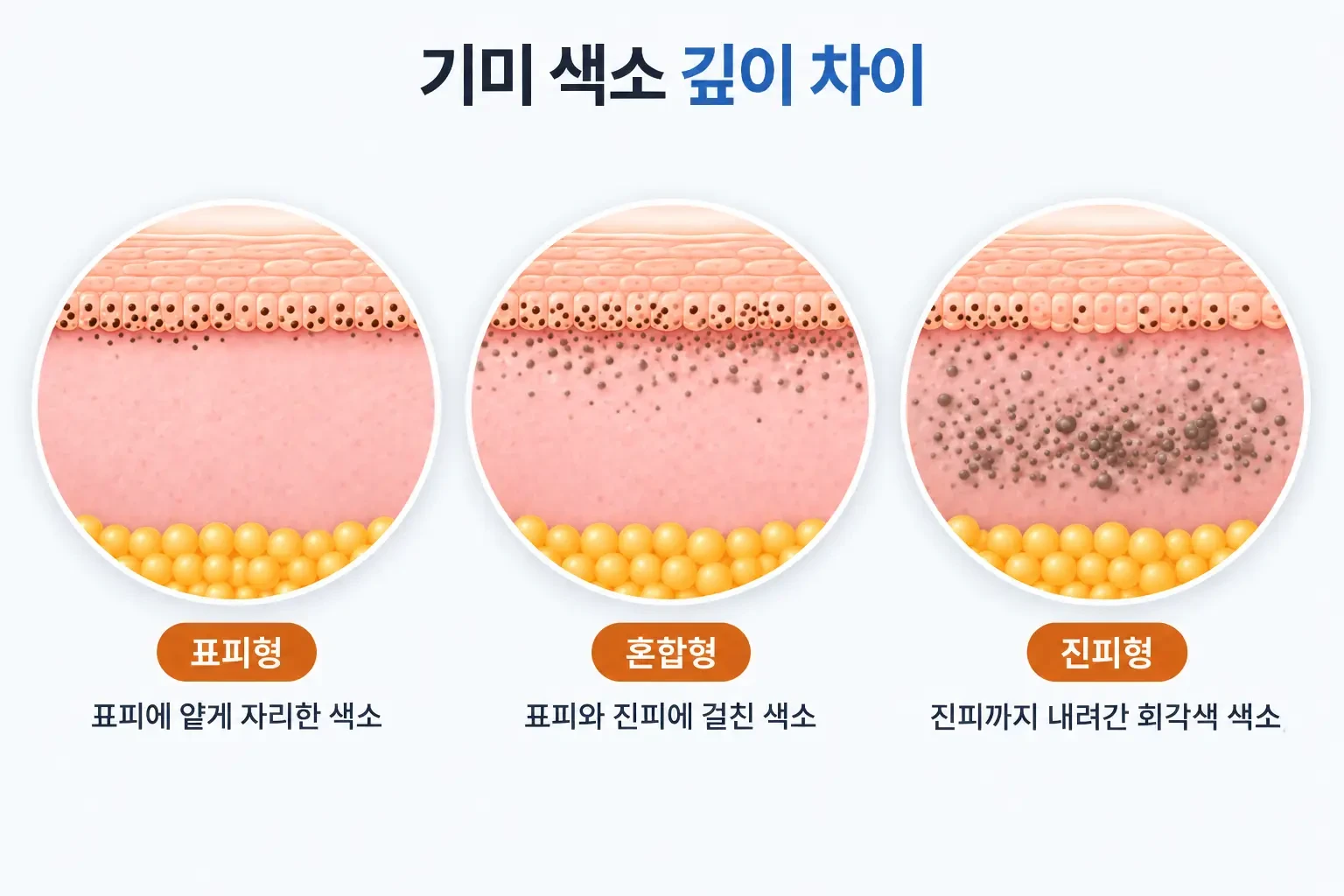 표피형, 혼합형, 진피형 기미 색소의 위치 차이를 동일 배율로 비교한 피부 단면 모식도
