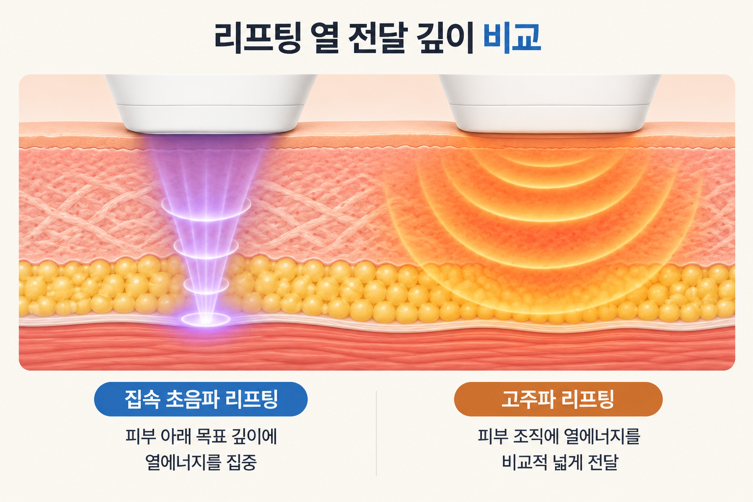 집속 초음파 리프팅의 피부 아래 목표 깊이 열에너지 집중과 고주파 리프팅의 진피·피하조직 열 전달 범위 비교