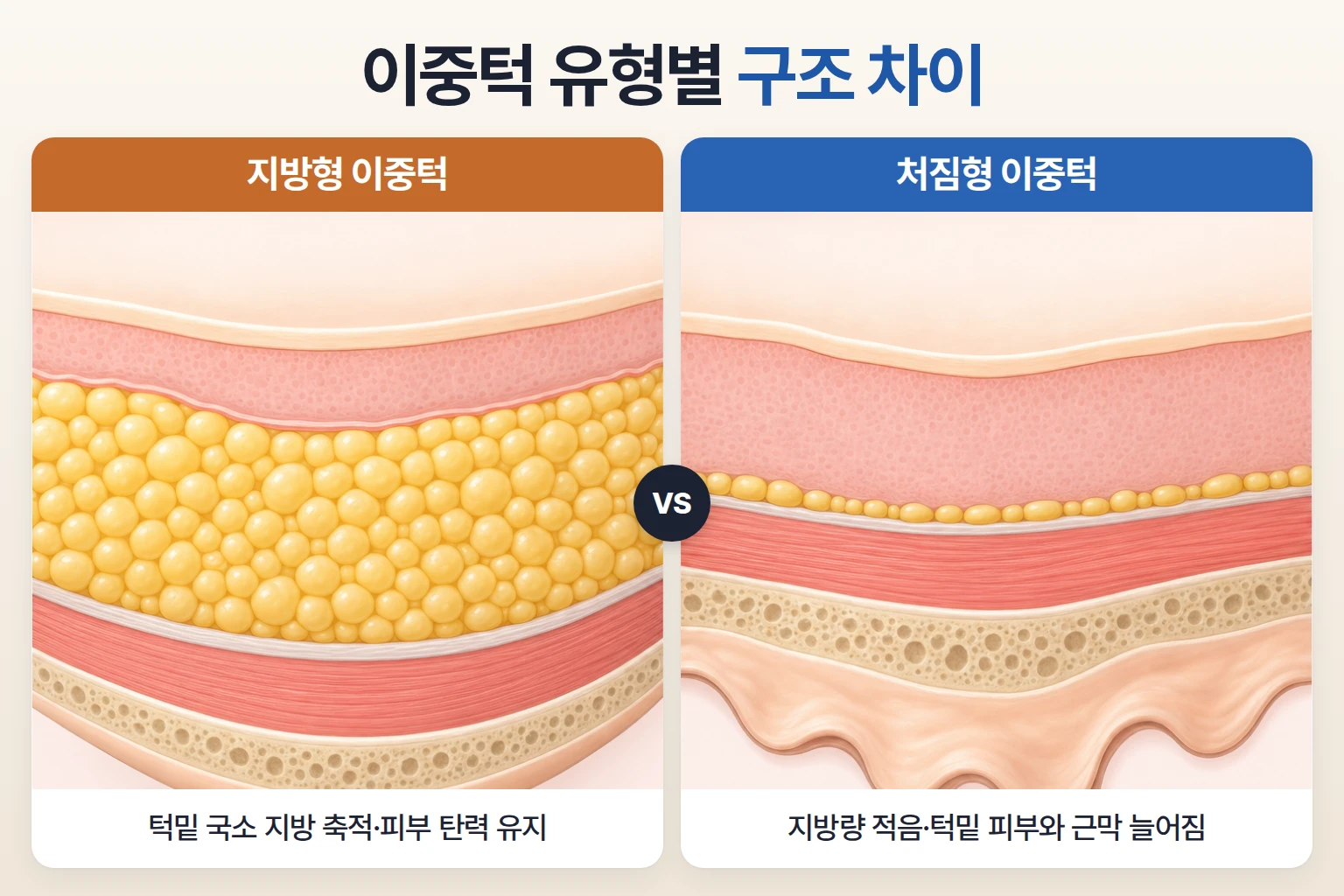 턱밑 지방이 쌓인 지방형 이중턱과 피부가 늘어진 처짐형 이중턱을 동일 배율로 비교한 조직 단면도