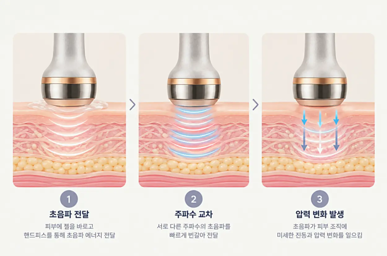 LDM이란 초음파 전달부터 주파수 교차, 피부 조직의 미세한 압력 변화까지 3단계 작용 원리를 보여주는 피부 단면도