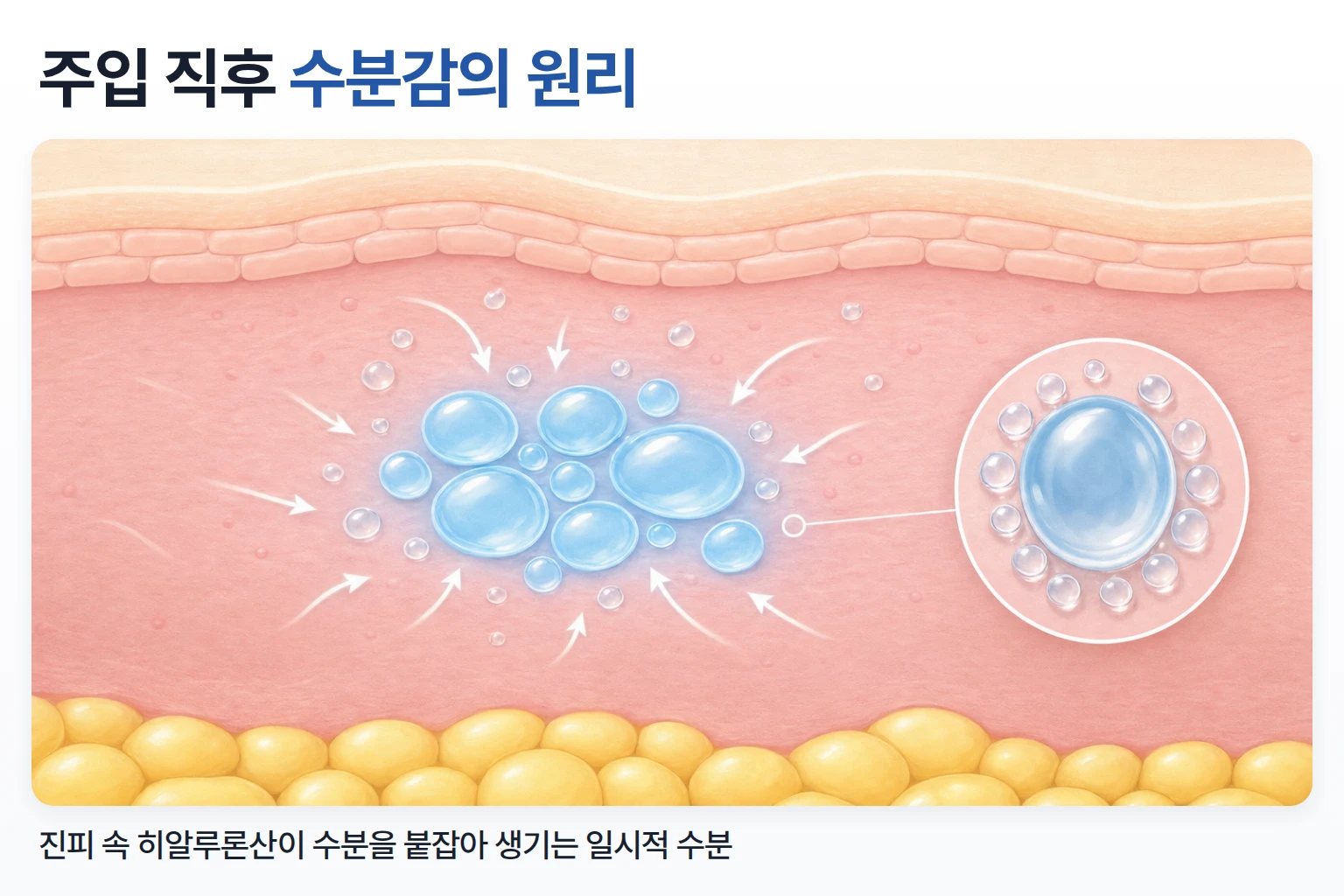 진피층에 주입된 히알루론산이 주변 수분을 끌어당겨 머금는 모습을 표현한 피부 단면 일러스트