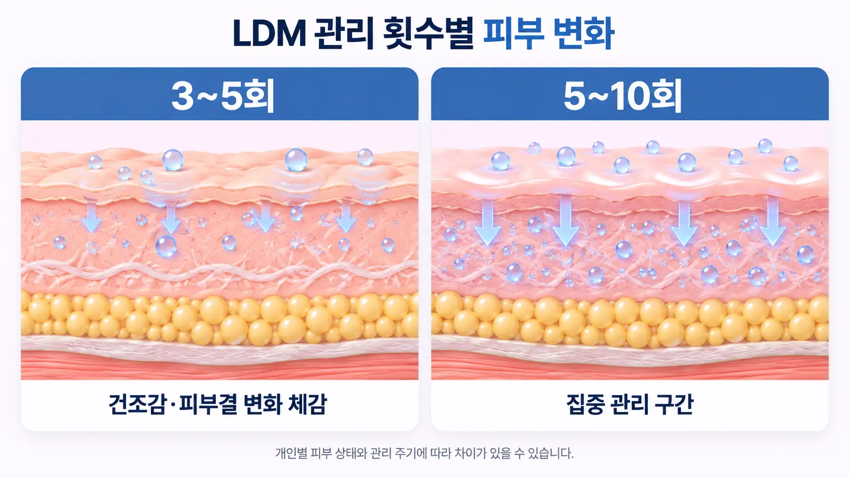 LDM 관리 횟수별 피부 변화 비교 이미지로, 3~5회 관리 시 건조감과 피부결 변화 체감 및 5~10회 집중 관리 구간을 피부 단면도와 수분 입자로 설명한 메디컬 일러스트