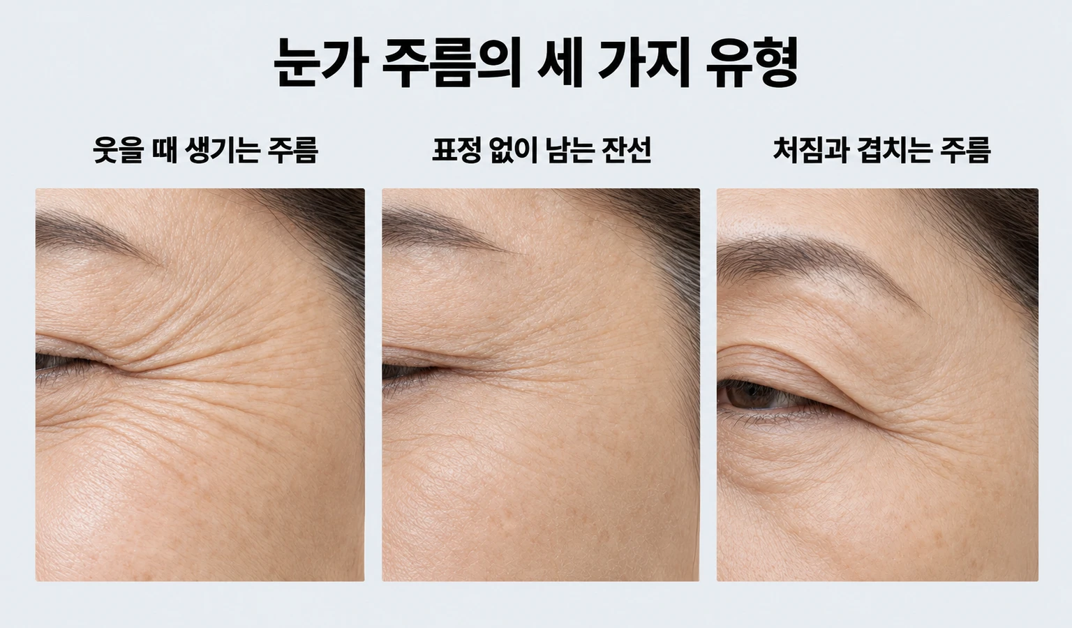 웃을 때 생기는 주름과 무표정 잔선·처짐이 겹친 눈가 주름 비교