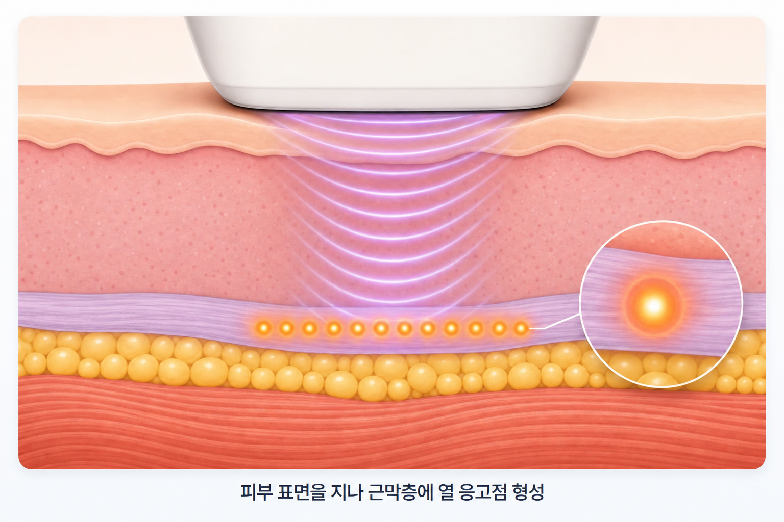 집속초음파 에너지가 피부 아래 근막층의 목표 깊이에 형성하는 열응고점