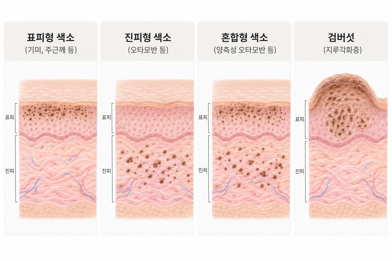 표피형 진피형 혼합형 색소와 융기된 검버섯의 피부 깊이와 구조 비교