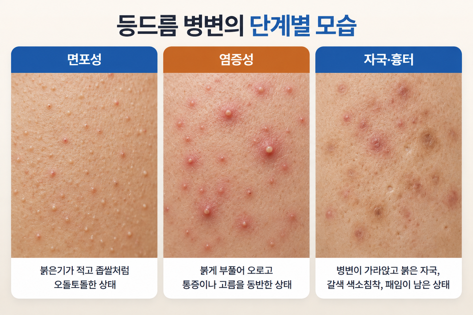 등드름 면포성 염증성 자국 흉터 단계별 피부 상태