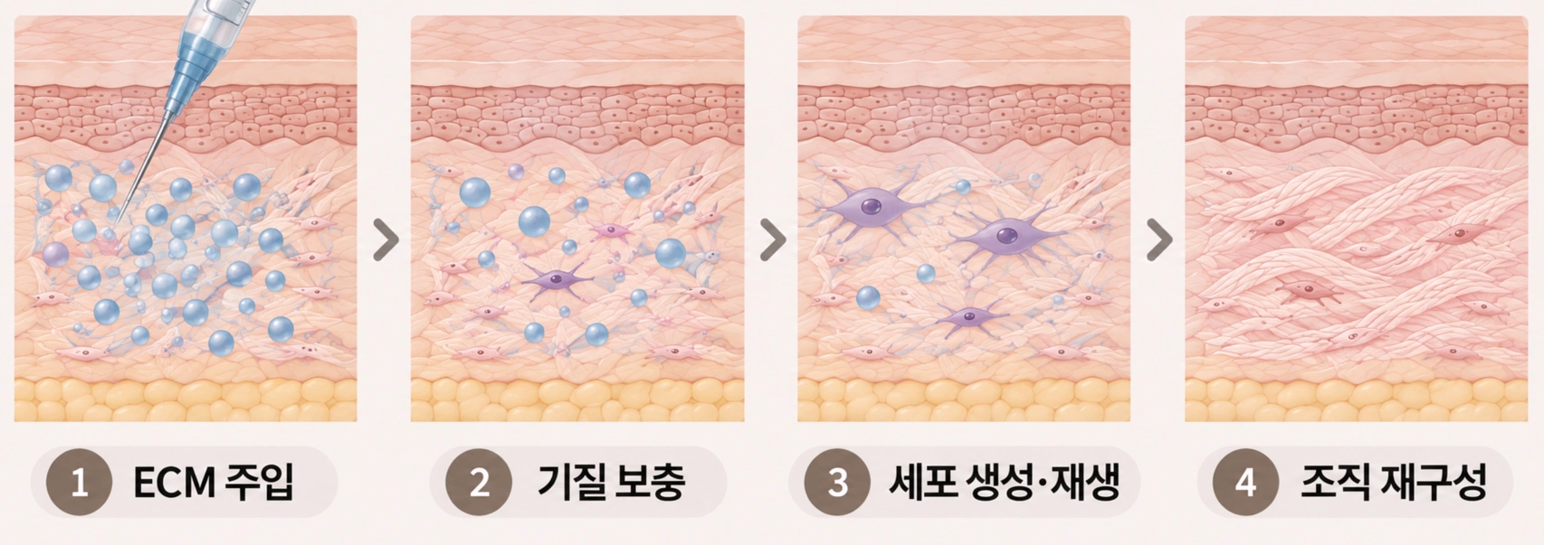 리투오 ECM 성분을 진피층에 주입한 뒤 세포외기질 보충과 피부 조직 재구성이 이어지는 과정을 4단계로 나타낸 피부 단면 모식도