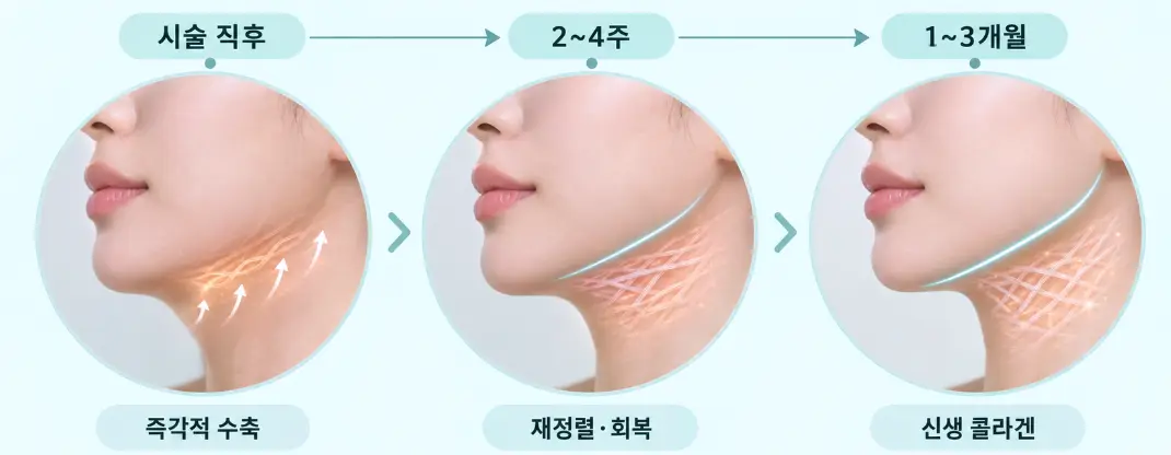 써마지 울쎄라 시술 후 시간 경과에 따른 피부 속 콜라겐 변화 흐름
