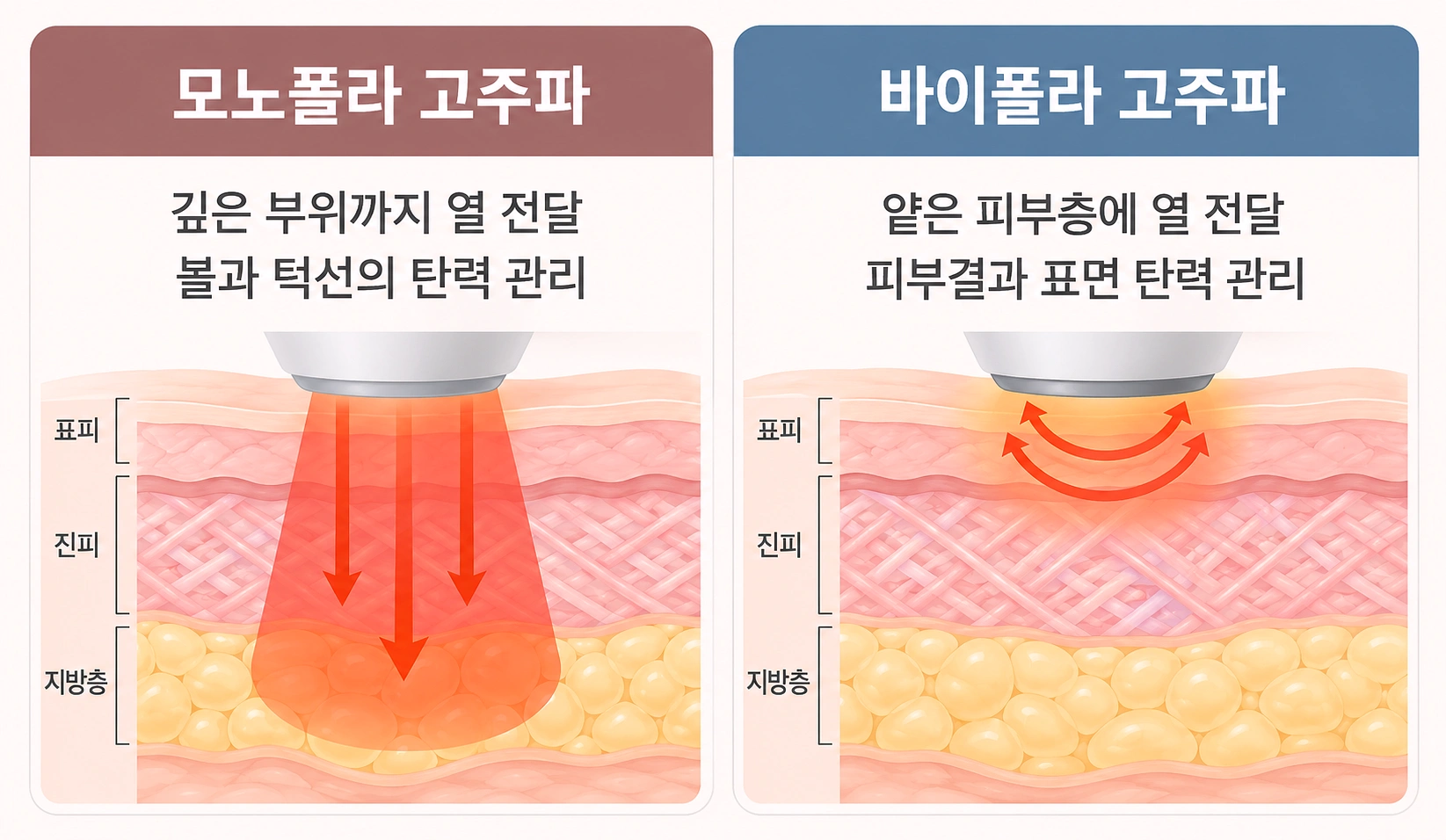 모노폴라와 바이폴라 고주파의 피부 열 전달 깊이 비교