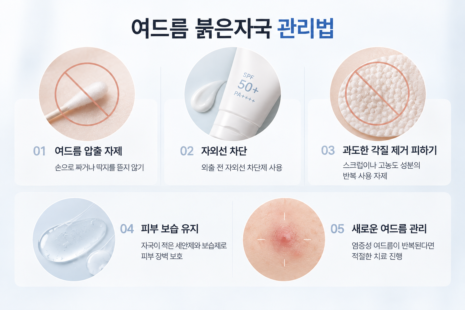 여드름 붉은자국 예방을 위한 손으로 짜는 행동 자제, 자외선 차단, 과도한 각질 제거 방지, 피부 보습 및 반복되는 염증성 여드름 관리 방법