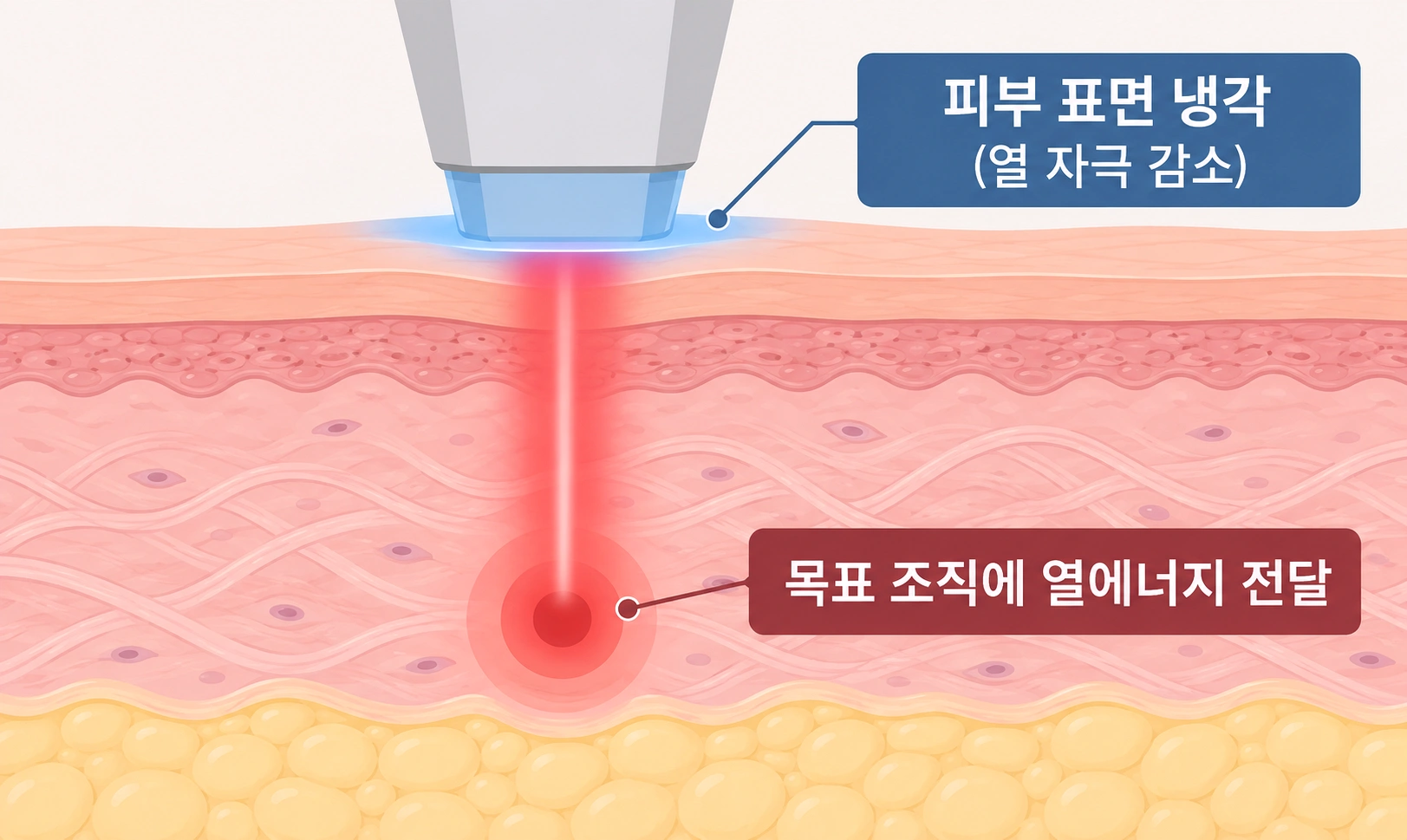 피부 표면 냉각과 목표 조직의 열에너지 전달 원리를 피부 단면도로 나타낸 클라리티 레이저 작용 원리 이미지