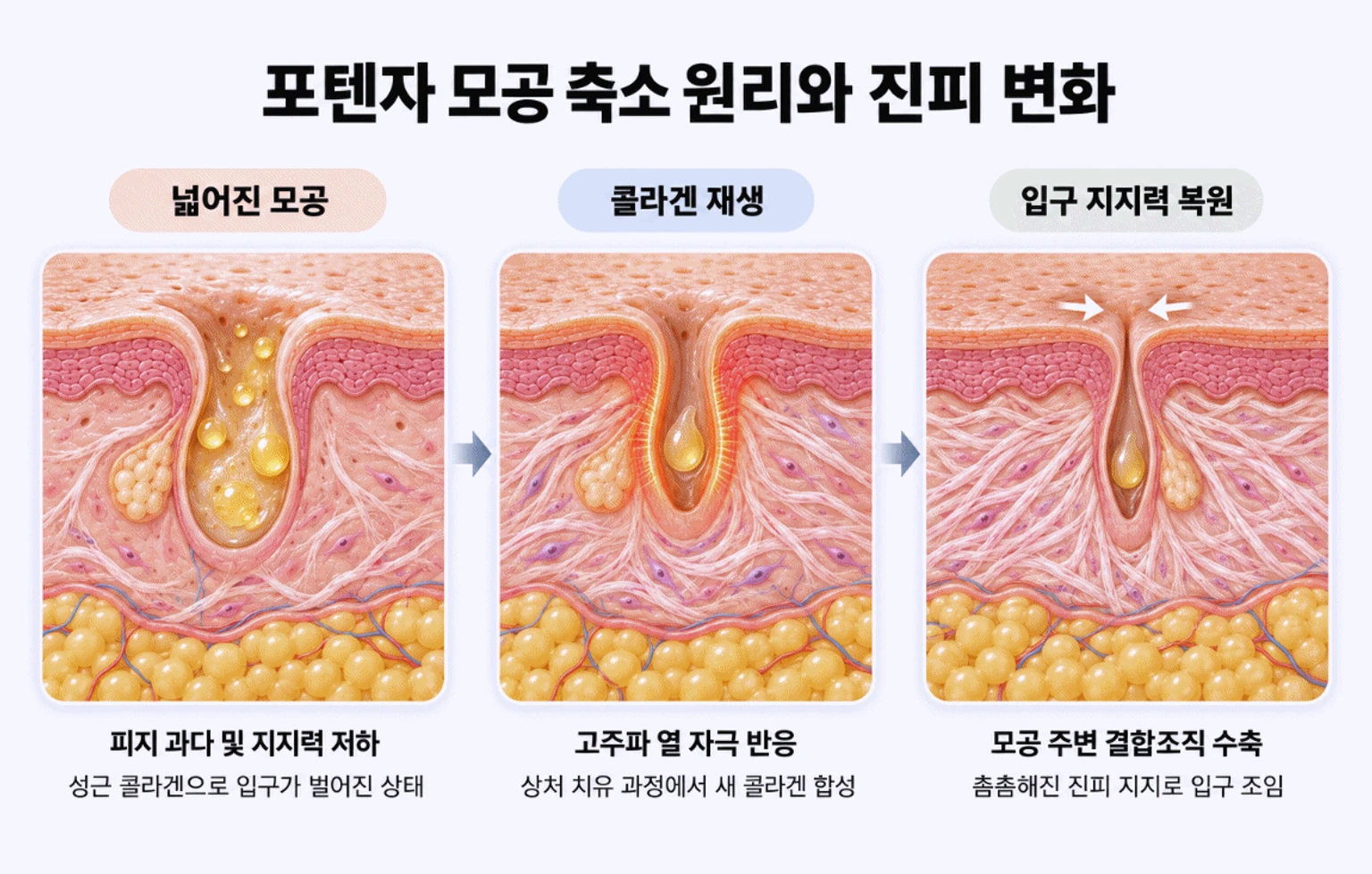 포텐자 레이저를 이용한 모공 축소 원리와 이에 따른 진피층 콜라겐 지지력 복원 과정을 보여주는 3단계 피부 단면 모식도