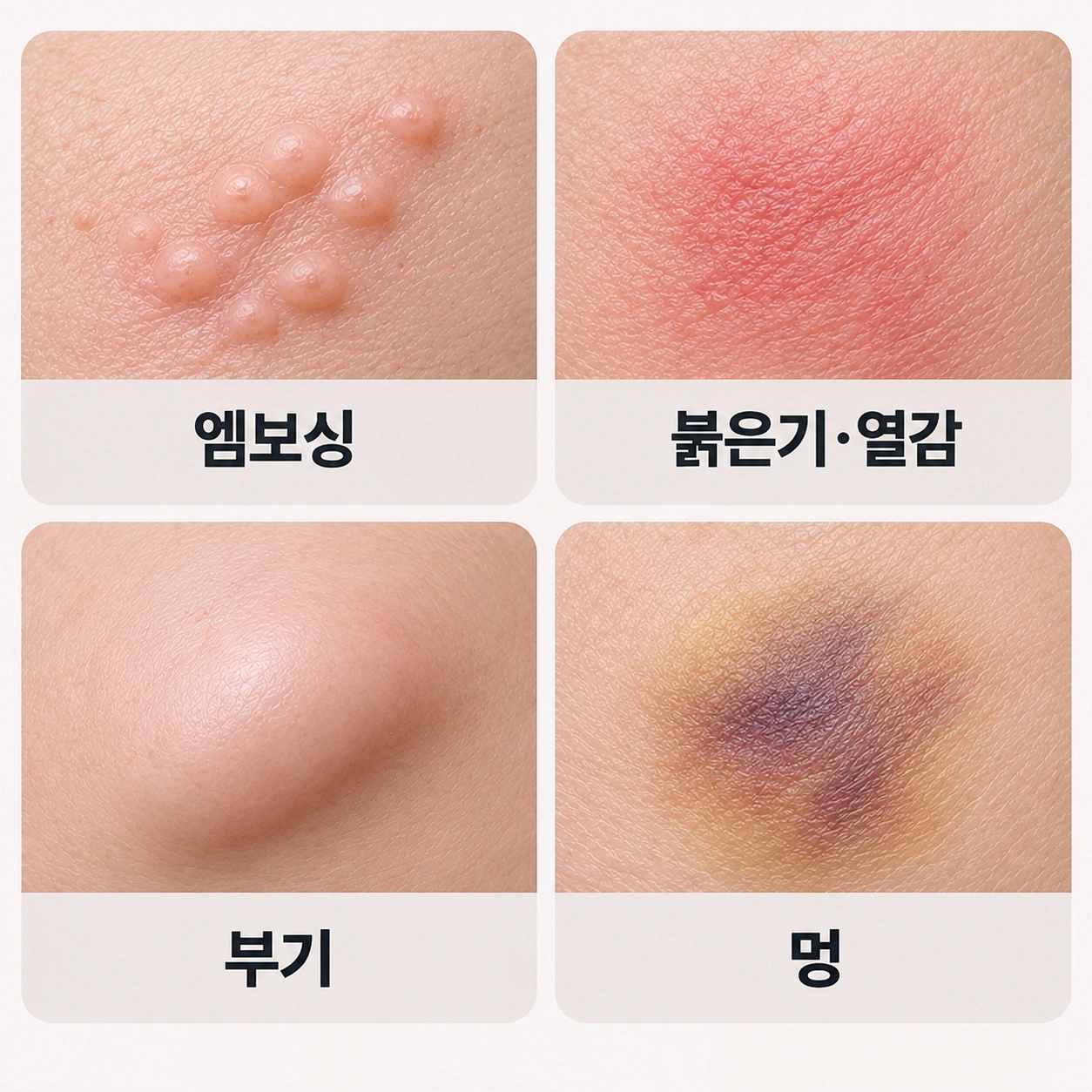 스킨부스터 시술 후 나타날 수 있는 엠보싱, 붉은기·열감, 부기, 멍의 피부 상태를 네 가지로 비교한 확대 사진