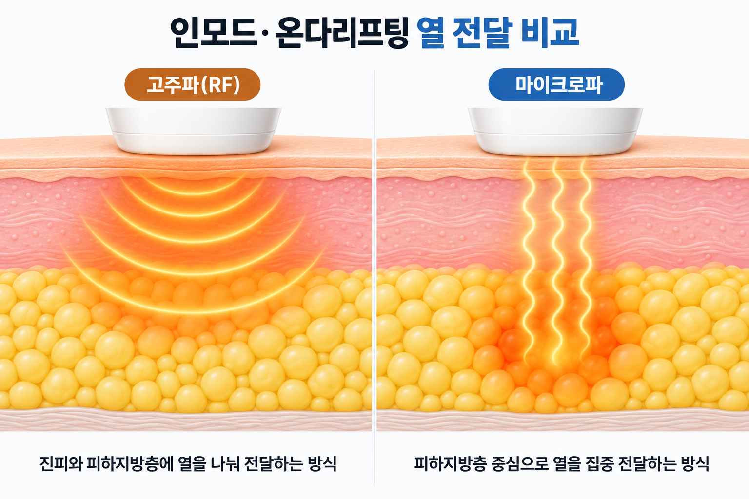 인모드 고주파와 온다리프팅 마이크로파의 피부 조직 열 전달 방식 비교