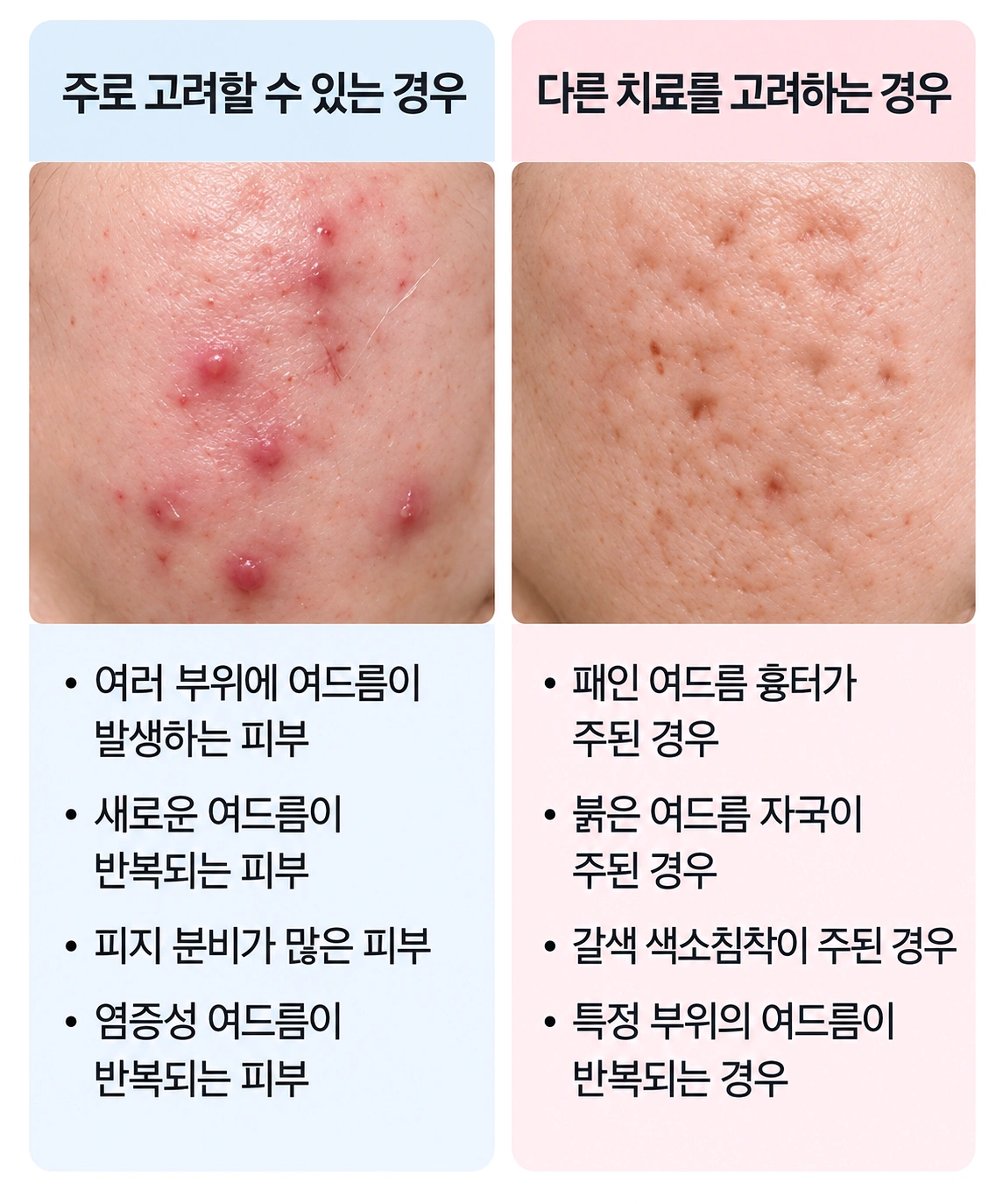 네오빔 레이저를 고려할 수 있는 여드름 유형과 다른 치료가 필요한 경우