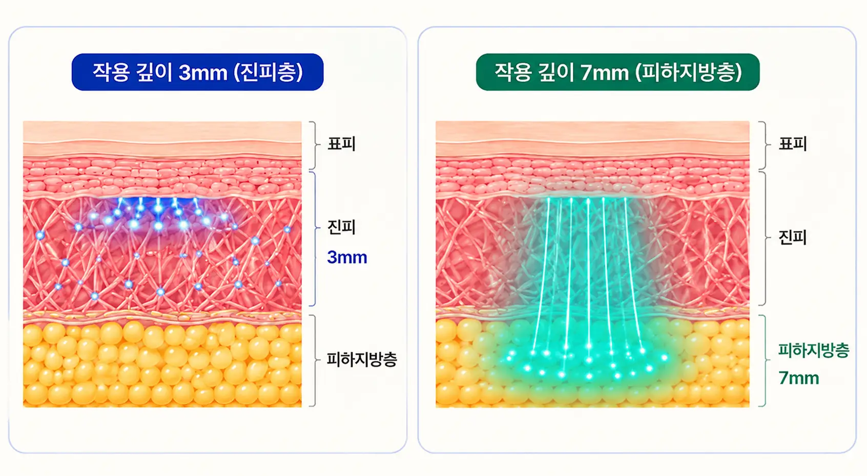 온다 리프팅 3mm·7mm 핸드피스의 작용 깊이와 타깃층 차이