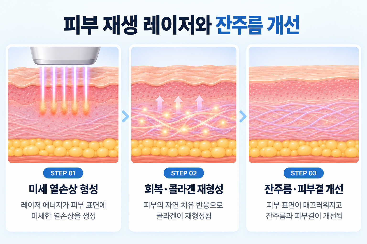 피부 재생 레이저의 미세 열손상 형성과 콜라겐 재형성, 잔주름 및 피부결 개선 과정