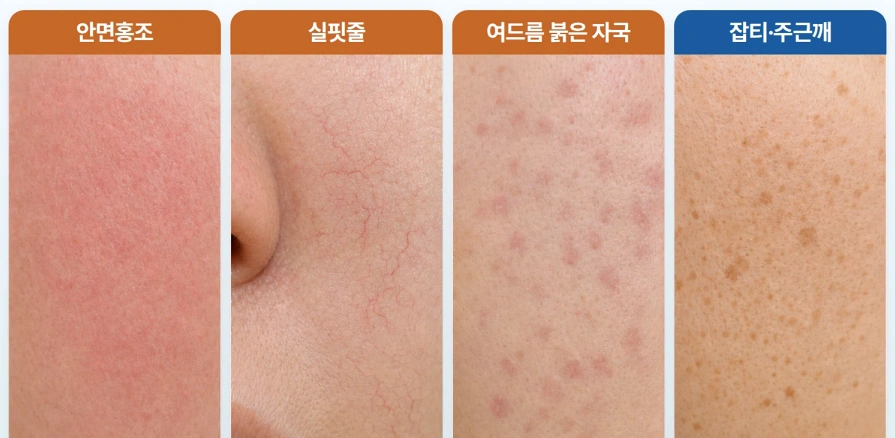 엑셀브이 레이저 적용을 고려할 수 있는 안면홍조, 실핏줄, 여드름 붉은 자국, 잡티와 주근깨의 피부 상태를 비교한 확대 사진