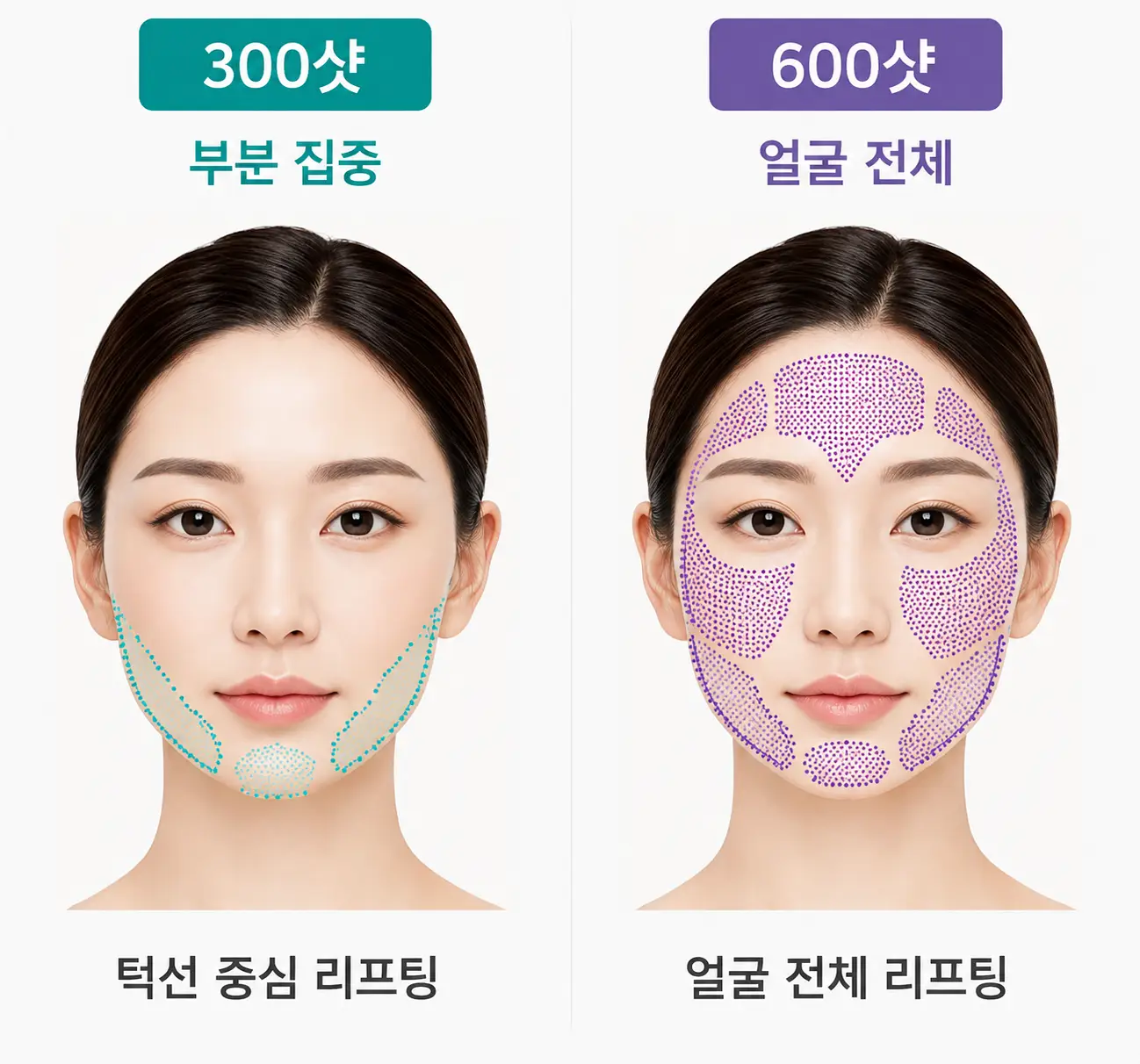 울쎄라 리프팅 300샷과 600샷 조사 범위 비교