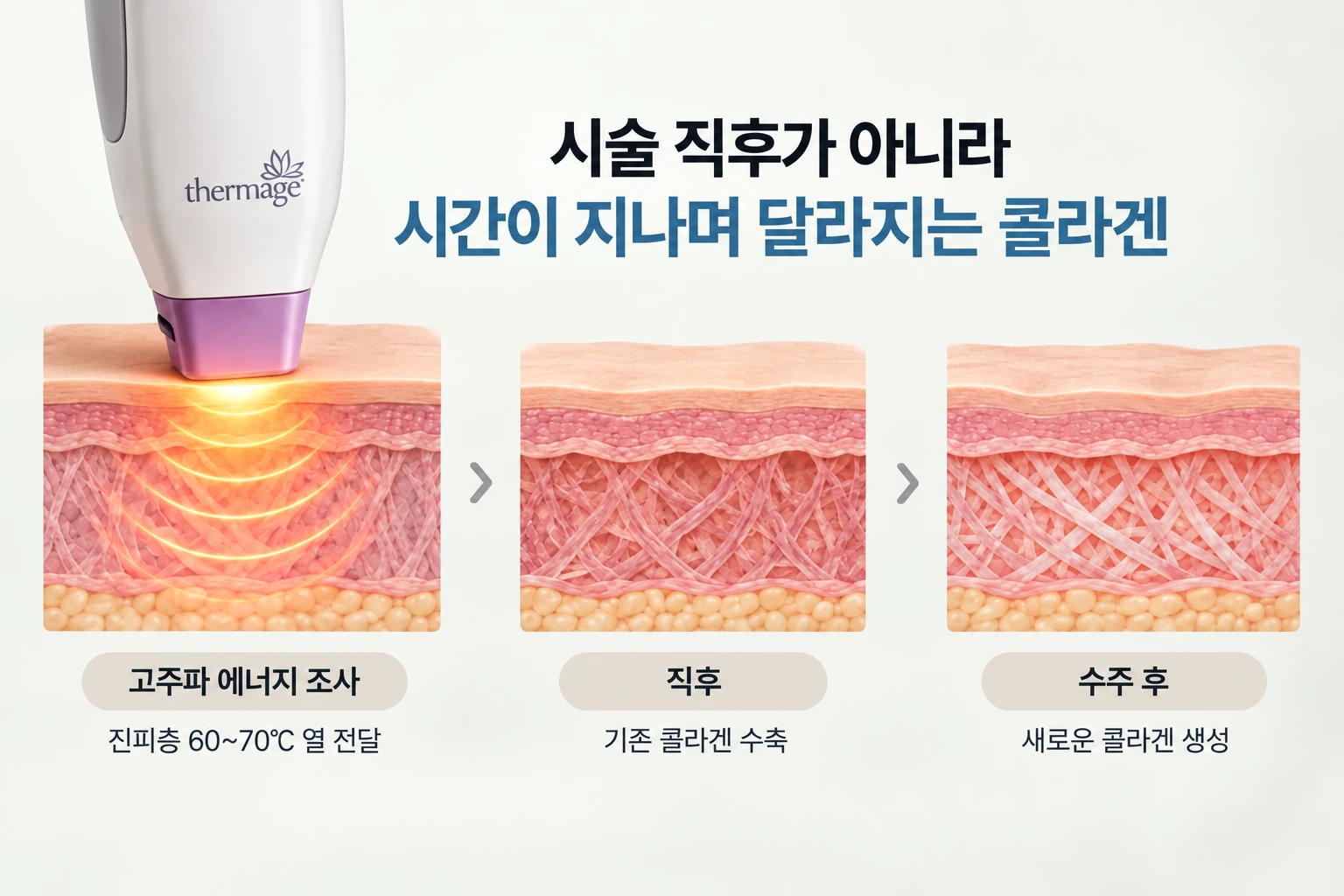 써마지효과없음 느끼는 이유 - 콜라겐 생성 지체