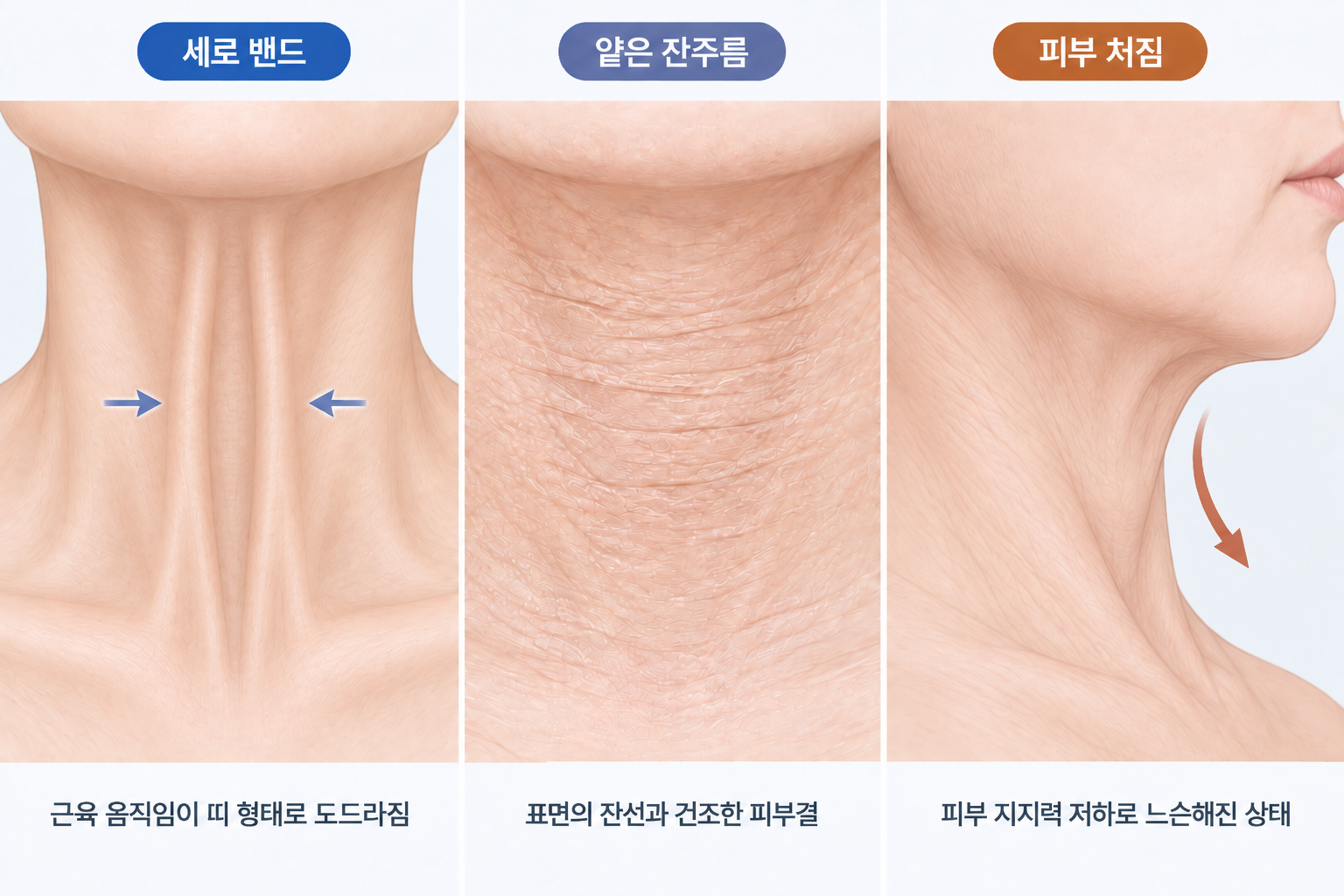 세로 밴드와 얕은 잔주름 피부 처짐에 따른 목주름 유형 비교