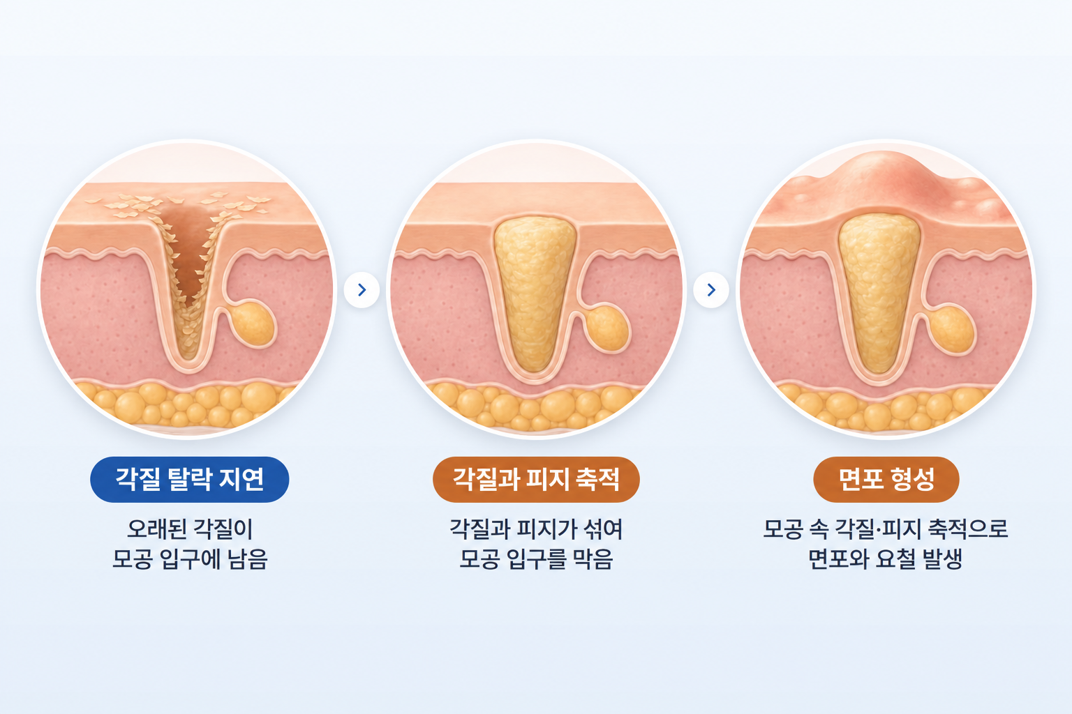 피부결이 오돌토돌해지는 과정, 모공 입구의 각질 탈락 지연부터 피지 축적과 면포 형성까지 3단계 피부 단면 변화