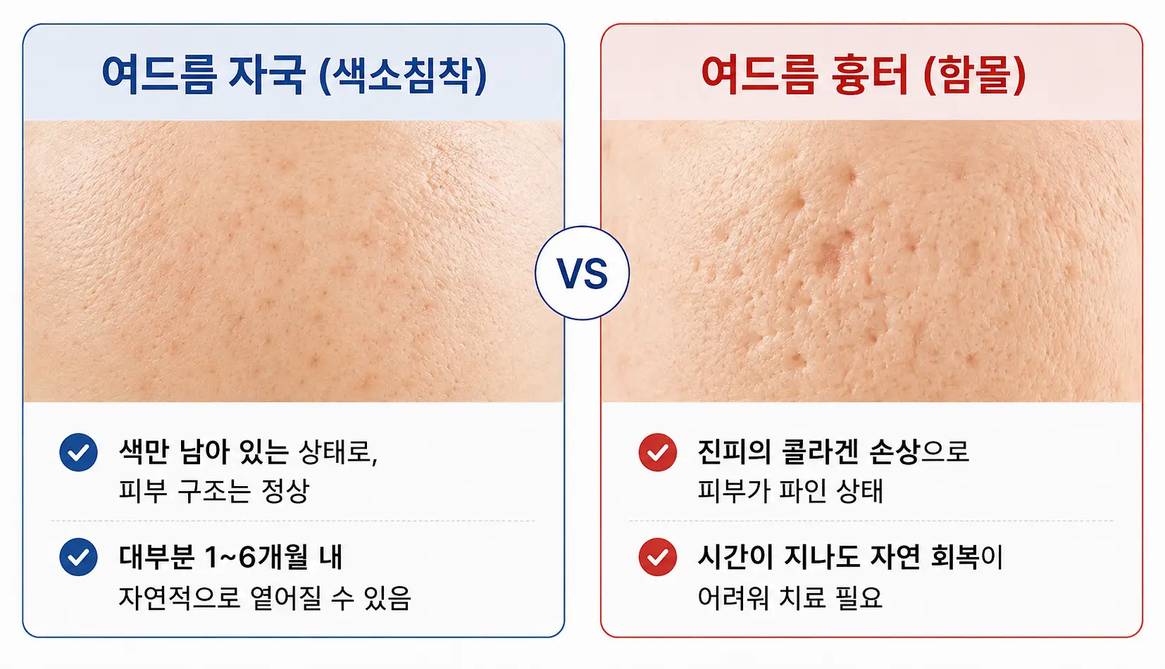 피부 여드름 흉터와 색소침착의 차이