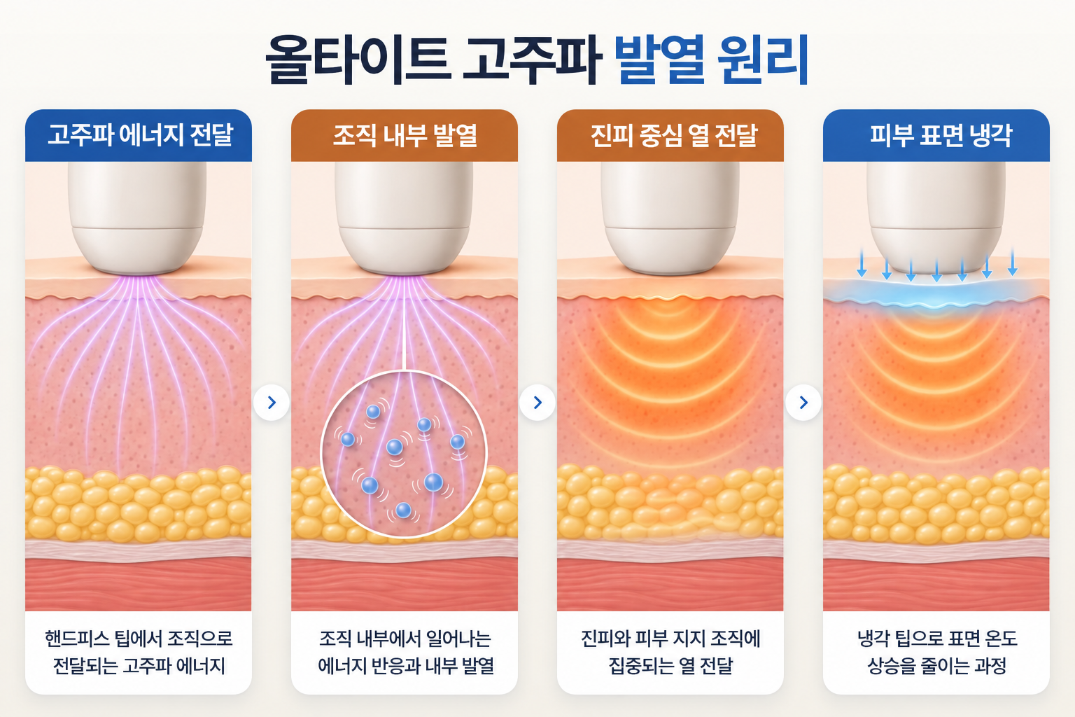 고주파 에너지 전달부터 진피 중심 발열과 피부 표면 냉각까지의 과정