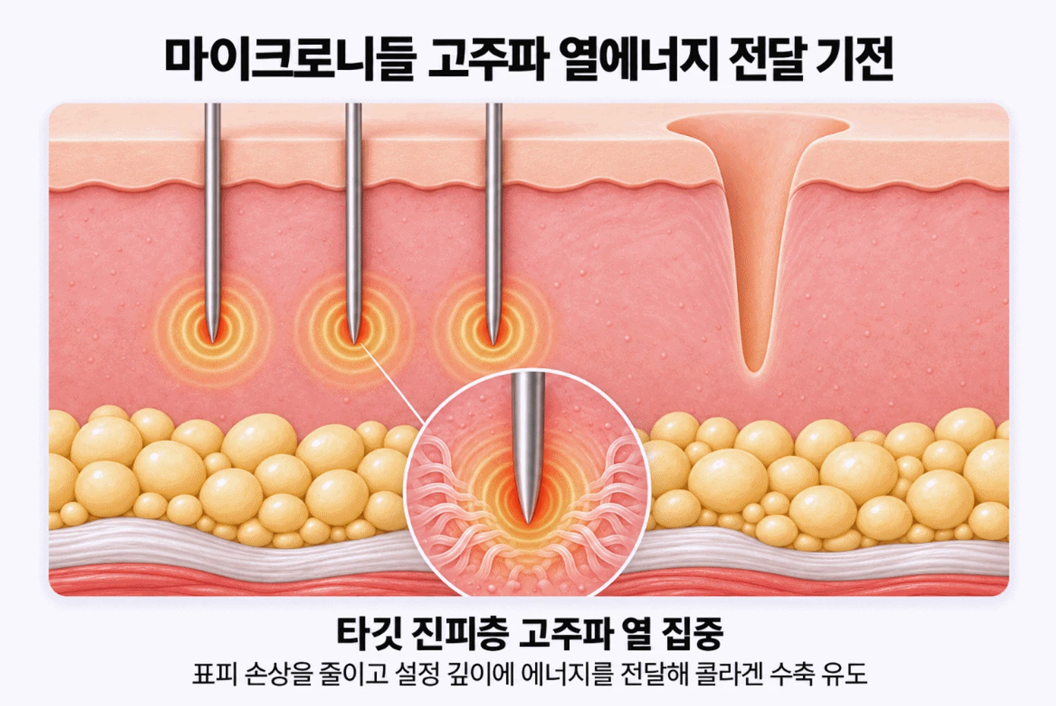 포텐자 마이크로니들이 진피 타깃 깊이에 도달하여 설정 깊이에 고주파 열에너지를 집중시키는 과정을 설명하는 피부 해부도