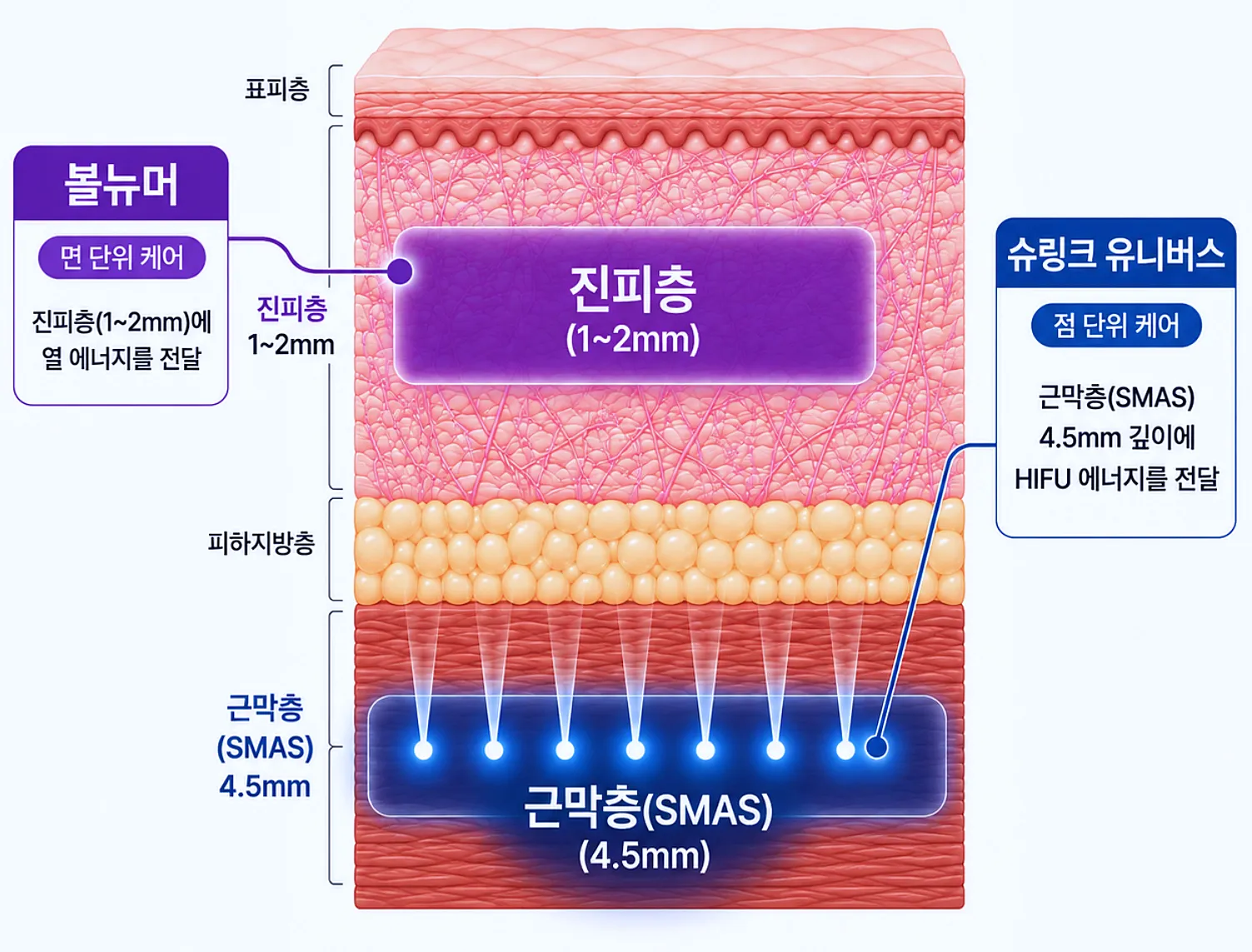볼뉴머 진피층과 슈링크 유니버스 근막층 작용 깊이 비교 단면도