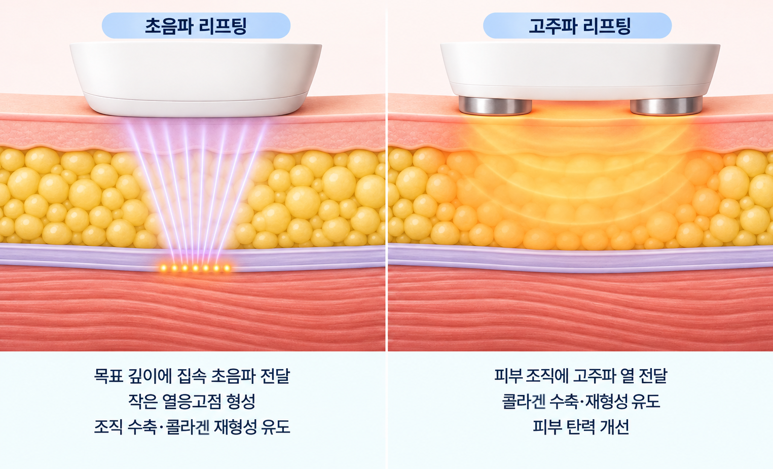 초음파 리프팅의 목표 깊이 열응고점 형성과 고주파 리프팅의 조직 내 열 전달을 비교한 피부 탄력 개선 원리